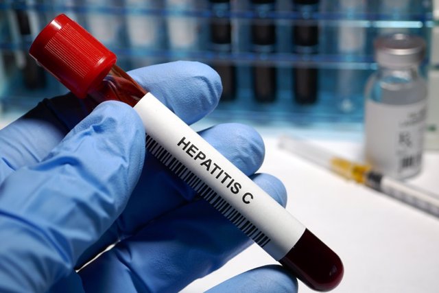 Archivo - Hepatitis C treatment  Hepatitis C - sexually transmitted disease blood test and treatment
