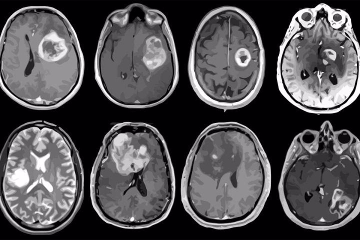 un-modelo-de-aprendizaje-profundo-clasifica-los-tumores-cerebrales-con