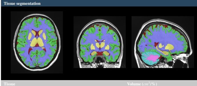 Investigadores de la Universitat Politcnica de Valncia (UPV) y el Centro Nacional para la Investigación Científica de Francia (CNRS, en sus siglas en francés), han desarrollado una nueva herramienta on line para el estudio del cerebro:  vol2Brain.