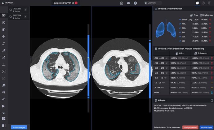 InferRead CT Pneumonia compares the progress of infection and quantifies changes over tim