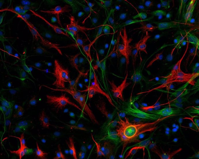 Glioblastoma mesenquimal de ratón con las células madre marcadas en color verde y las células diferenciadas en rojo.