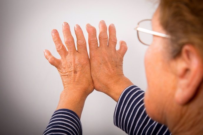 Archivo - Hand Deformed From Rheumatoid Arthritis