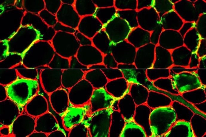 Archivo - Las células inmunitarias (verdes) se amontonan alrededor de las fibras musculares (rojas), dañándolas y causando dolor y debilidad muscular. Investigadores de la Escuela de Medicina de la Universidad de Washington en St. Louis han identificado