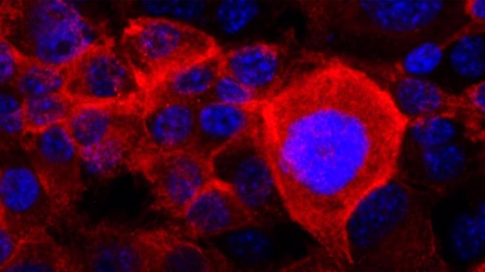 Archivo - La mayoría de las células de cáncer de páncreas tienen mutaciones en el gen KRAS que permiten un crecimiento no regulado. En esta imagen, la versión mutante y cancerígena de la proteína KRAS se tiñe de rojo en las células de cáncer de páncreas.