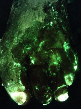 MolecuLight i:X Receives FDA 510(k) Clearance for the Device's Ability to Detect Wounds Likely to Contain Pseudomonas aeruginosa (PA)