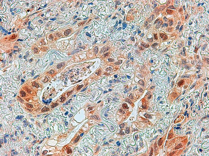 Imagen al microscopio de un adenocarcinoma de pulmón con la proteína ERK5 marcada en marrón en las células tumorales. Cáncer de pulmón.