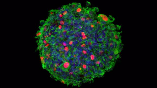 Imagen 3D de inmuno-microscopía confocal de una neuroesfera originada por células madre aisladas de un paciente de glioblastoma (GSC), e infectadas por el parvovirus Minute Virus of Mice (MVM).