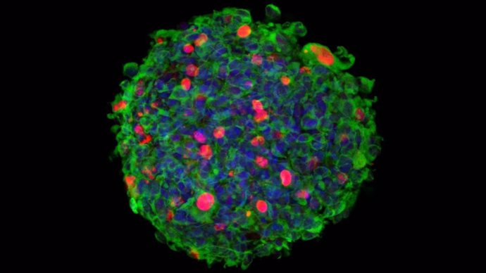 Imagen 3D de inmuno-microscopía confocal de una neuroesfera originada por células madre aisladas de un paciente de glioblastoma (GSC), e infectadas por el parvovirus Minute Virus of Mice (MVM).