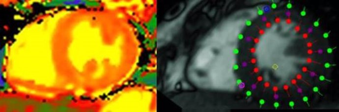 Corte axial del corazón con vista de los ventrículos derecho e izquierdo. Izqda: técnica de mapping en la que se aprecia la sangre en amarillo y la inflamación en naranja. Dcha: técnica de feature tracking que muestra la contractilidad cardiaca.