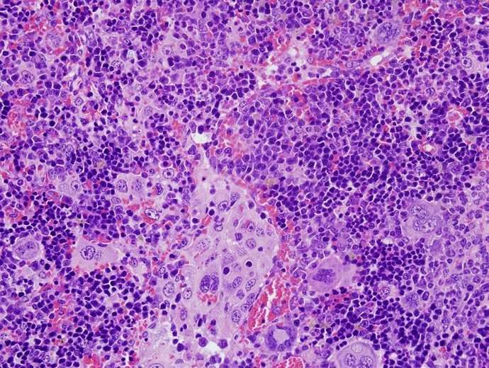 Archivo - Imagen de microscopia de un linfoma desarrollado por ratones con alteraciones en el gen VAV1.