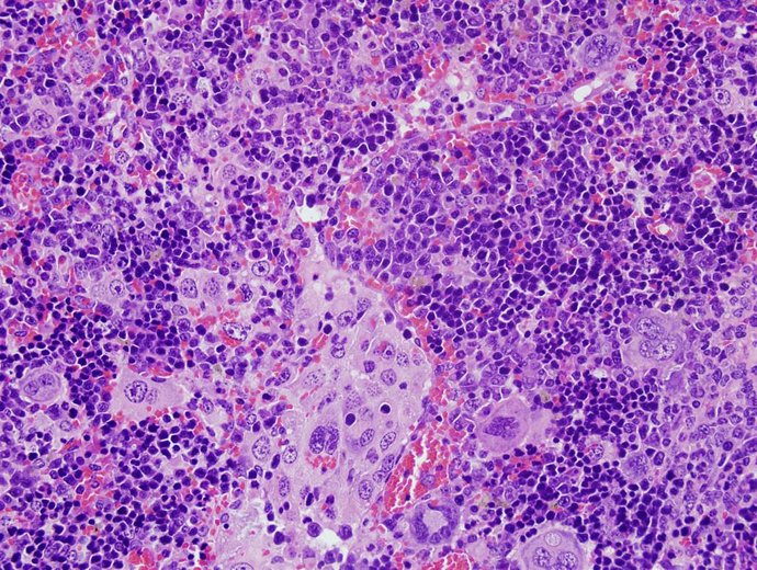 Imagen de microscopía del bazo de un ratón que ha desarrollado un linfoma periférico de células T a causa de alteraciones en el gen VAV1.