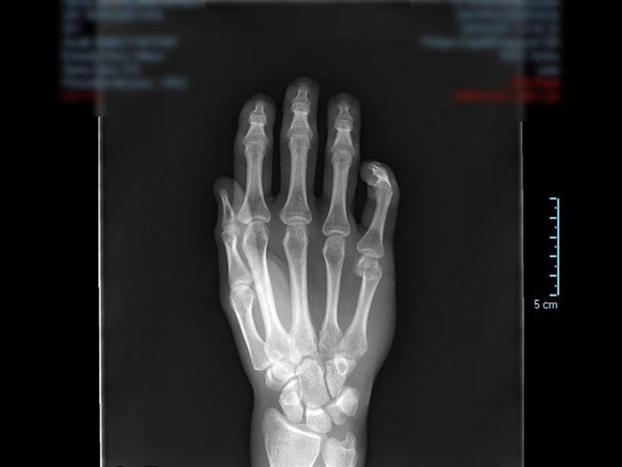 Radiografía de una mano