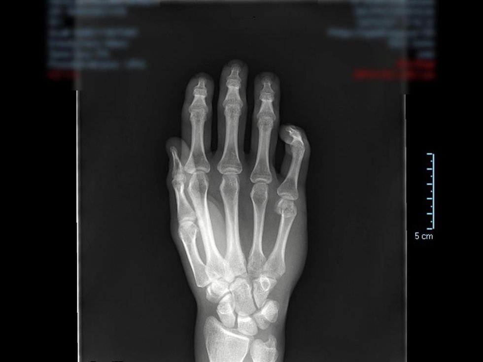 Radiografía de una mano