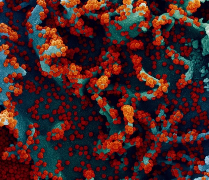 Micrografía electrónica de barrido coloreada de una célula infectada con SARS-CoV-2.