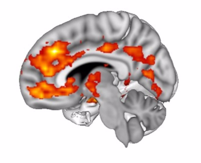 Identificada una nueva forma de autismo caracterizada por neuronas con demasiadas sinapsis