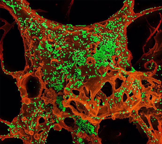 Archivo - Micrografía electrónica de barrido en color de células de mamífero infectadas con el coronavirus del síndrome respiratorio de Oriente Medio (MERS).