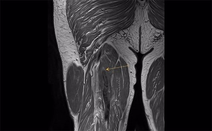 Rotura del músculo semimembranoso con retracción. El músculo toma forma de acordeón indica que ha perdido tensión.