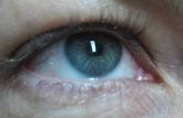 Foto: Detectan alteraciones en la retina producidas por la ELA