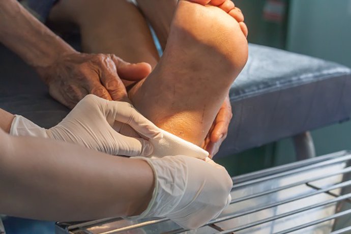 La diabetes mellitus, responsable del pie diabético, es la causa más frecuente de amputación de pierna en el mundo occidental.