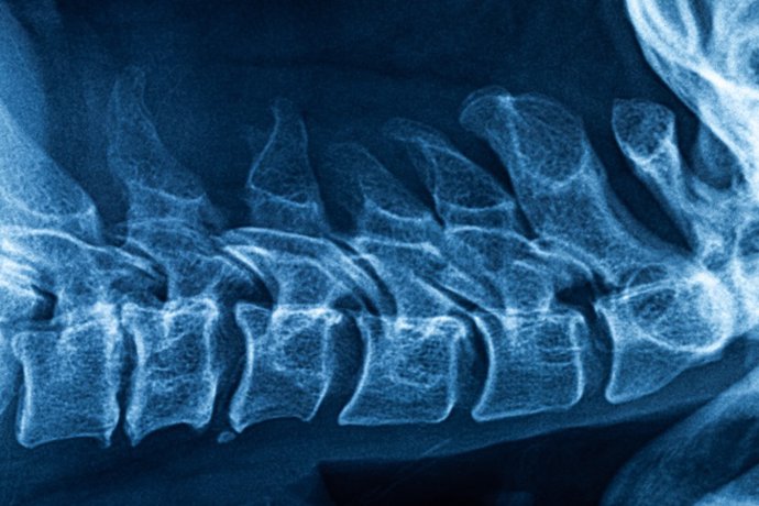 Archivo - Película de rayos X del puente de vértebras cervicales