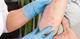Foto: El 75% de los pacientes con psoriasis presenta manifestaciones clínicas más allá de las conocidas placas de la piel