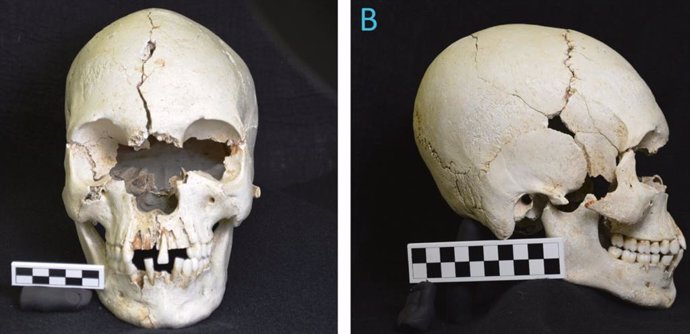 Forntal y lateral del cráneo con evidencia de lepra descubierto en el Caribe