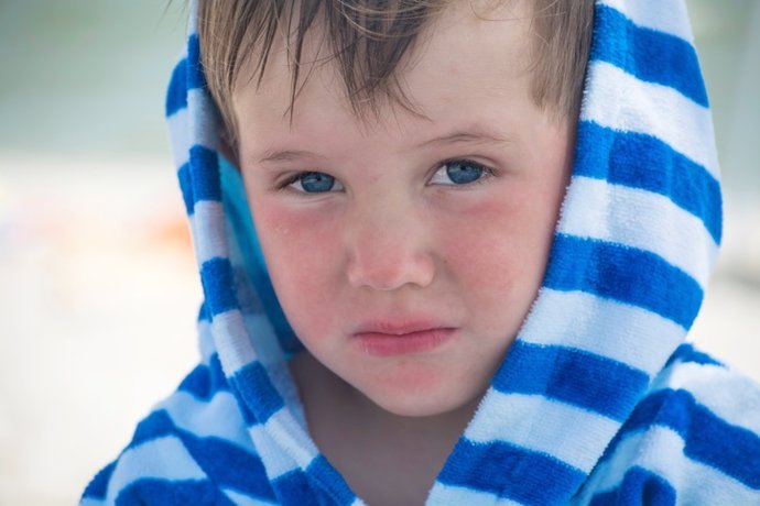 Archivo - Un niño con dermatitis atópica en una imagen de archivo. 