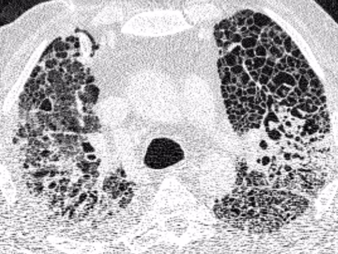 Imagen de tomografía computarizada de tórax (TC de tórax) de un paciente con insuficiencia respiratoria relacionada con COVID-19. Las áreas claras muestran densidades de tejido pulmonar y cicatrices.