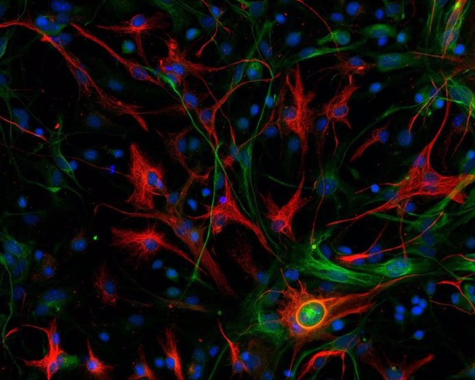 Archivo - Glioblastoma mesenquimal de ratón con las células madre marcadas en color verde y las células diferenciadas en rojo.