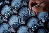 Foto: La epilepsia incrementa su prevalencia a partir de los 60 años