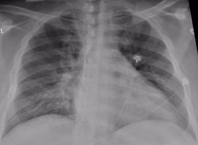 Archivo - La radiografía de tórax de un paciente positivo de COVID-19 que muestra una neumonía en la parte inferior de los pulmones.