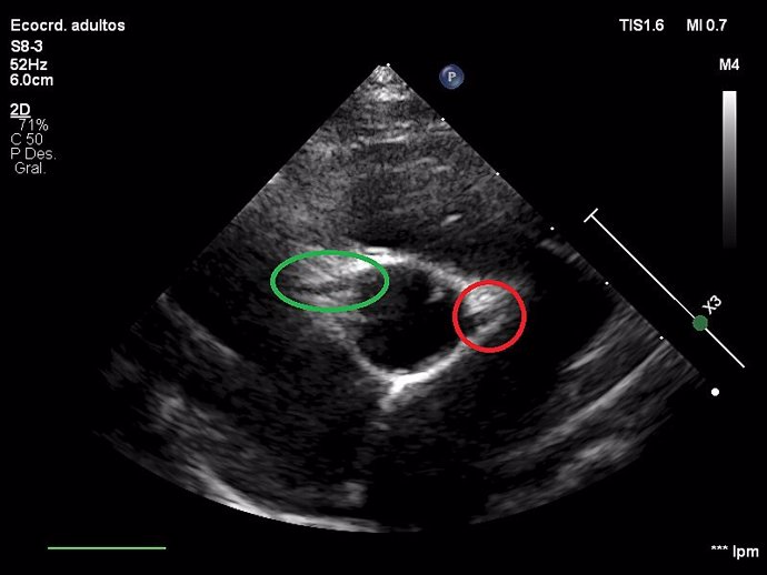Imagen de un ecocardiograma en el que aparecen ambas arterias coronarias. Redondeada de color rojo la arteria coronaria izquierda y de color verde la arteria coronaria derecha