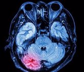 Foto: ¿Detectar las conmociones cerebrales mediante un análisis de orina?