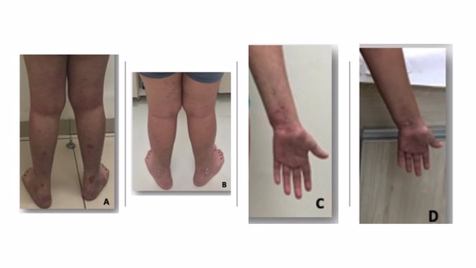 Un paciente con lesiones de dermatitis atópica en piernas y brazos (A y C) . Fotografiado tras un periodo de 18 meses de tratamiento (B y D) tras el cual la paciente mostró una notable mejoría
