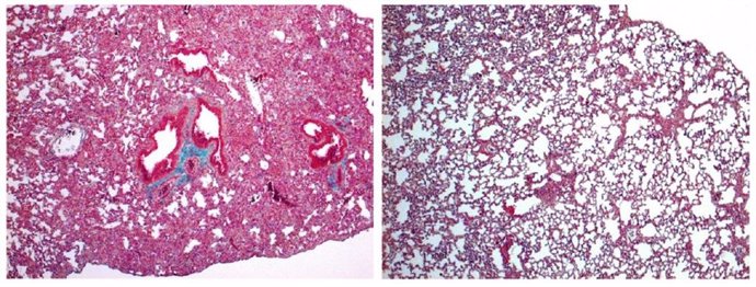 Archivo - A la izquierda, pulmón de ratón con signos de fibrosis pulmonar grave. A la derecha, pulmón de ratón tratado con cortistatina, en el que el daño es mucho menor.