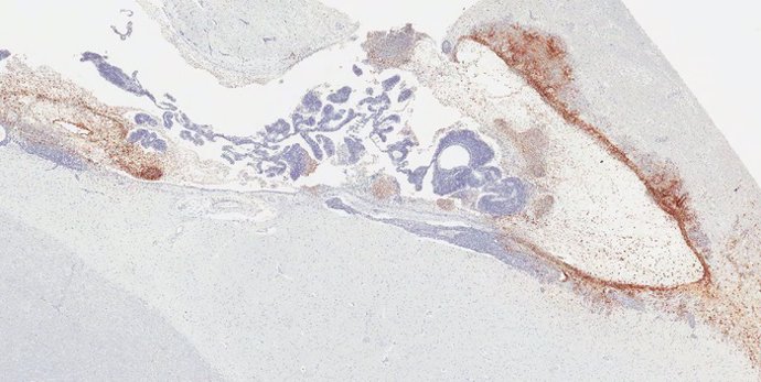 Recaídas del virus del Ébola (marrón) en el sistema ventricular del cerebro y la neuropila adyacente en un mono rhesus que sobrevivió a la exposición al virus del Ébola tras el tratamiento con anticuerpos monoclonales. (Los núcleos se tiñen de azul).