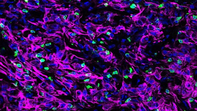 Un corte transversal de tejido tumoral pancreático de ratón. Estas células cancerosas (teñidas de púrpura) carecen de una proteína llamada KRT19 en su capa externa que forma parte de un complejo que desactiva el movimiento de las células T (verde).