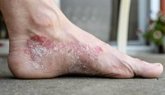 Foto: Más de 2,3 millones de personas padecen psoriasis en España, de las cuales en torno a 14.000 tienen artritis psoriásica