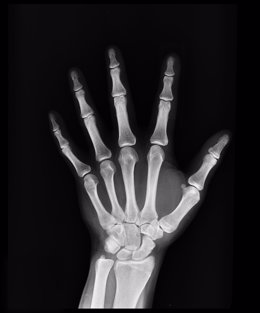Archivo - Radiografía de mano
