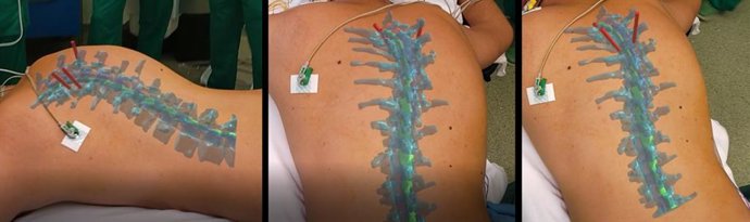 Fisabio-UMIB crea un sistema de realidad aumentada que mejora el resultado de la cirugía de la escoliosis