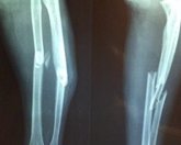 Foto: Solo el 40% de pacientes que sufren una fractura por osteoporosis recuperan su calidad de vida