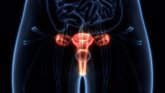 Foto: La endometriosis y el cáncer de ovario, ligadas genéticamente: esta es la conexión