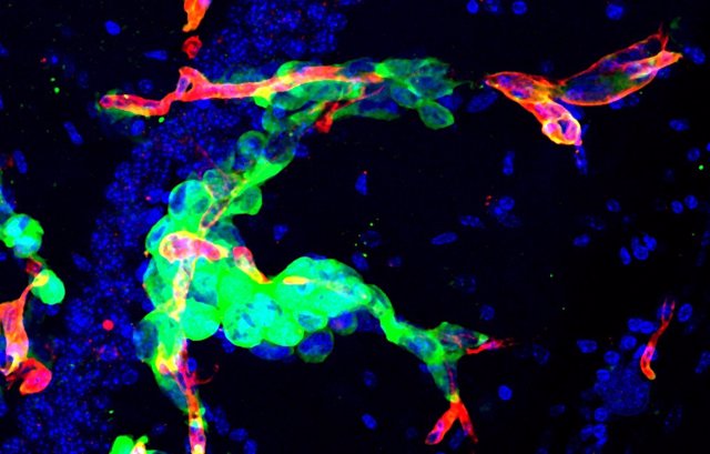 Archivo - Imagen de la metástasis en cerebro de ratón. En verde, células tumorales que permanecen ‘escondidas’ después de una cirugía y que actúan como potenciales semillas para la reaparición de la metástasis.