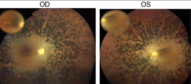 Fondo de ojo del paciente con retinitis pigmentosa en el que se ha identificado la mutación en el gen CFAP20. OD=ojo derecho, OS=ojo izquierdo.