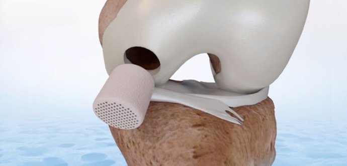 FDA approves CartiHeals Implant for the Treatment of Cartilage and Osteochondral Defects