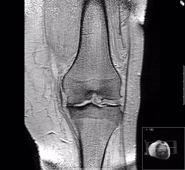 Archivo - Artrosis de rodilla