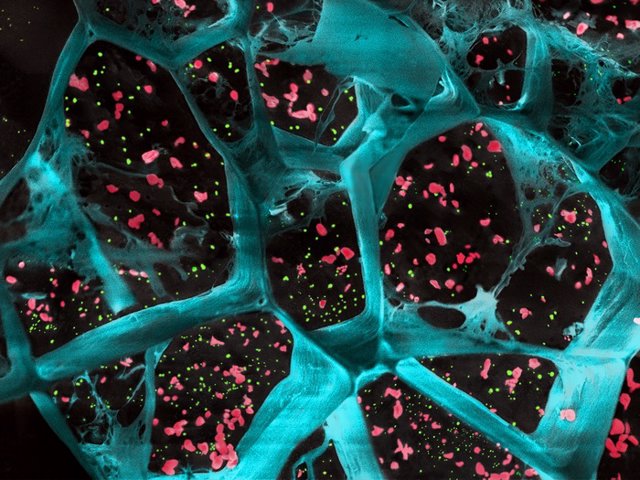 Una ampliación del hidrogel (en azul) que encapsula plaquetas activadoras de células T (en rojo) y nanopartículas que liberan un fármaco para inhibir las células potenciadoras del tumor (en verde).