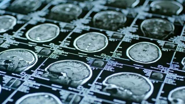 Archivo - Imágenes de resonancia magnética de un cerebro
