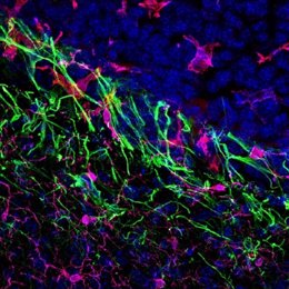 Archivo - Metástasis cerebral de melanoma en ratón.