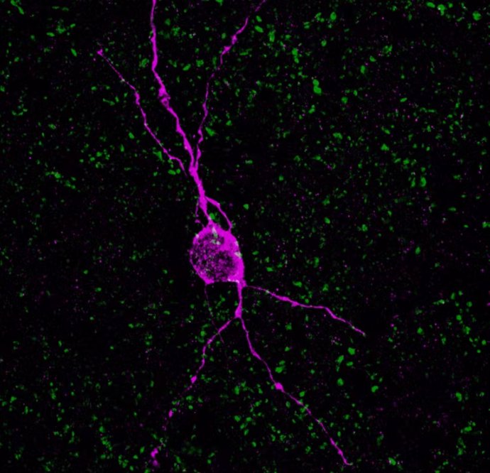 Neurona inmadura en una mujer de 60 años.